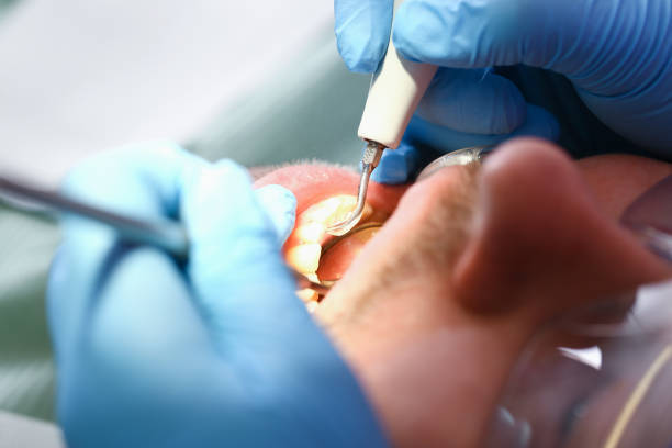 Best Emergency Root Canal Treatment in Aptos Hills Larkin Valley, CA